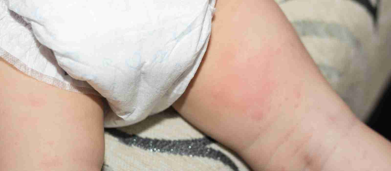 Can Diaper Rash Cause Blisters
