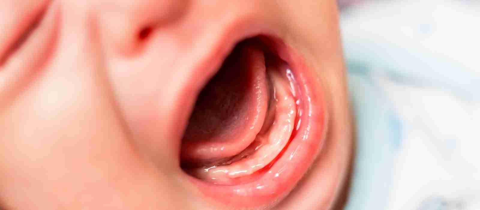 Tongue Tie And Breastfeeding