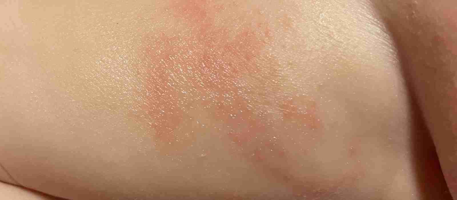 Diaper Rash Usmle at Michelle Wang blog