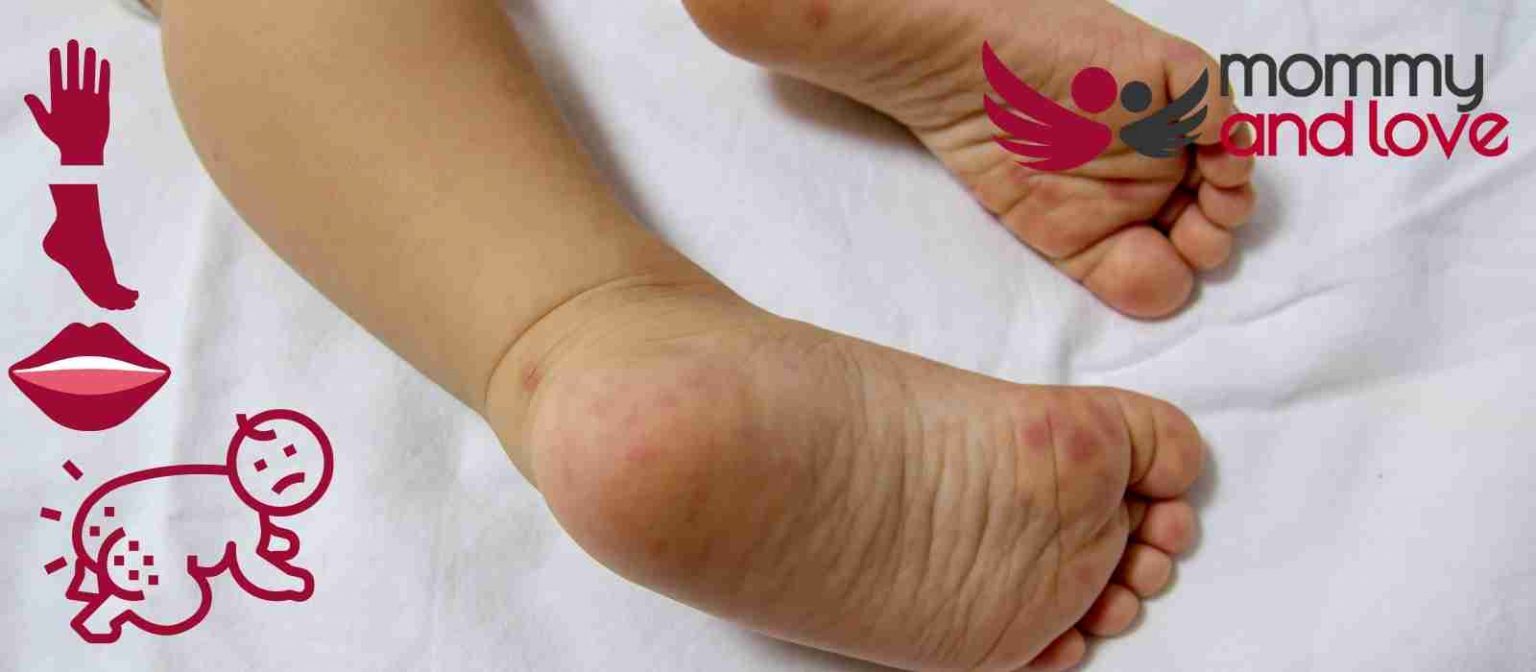 Can Hand Foot and Mouth Cause Diaper Rash? Mommy and Love