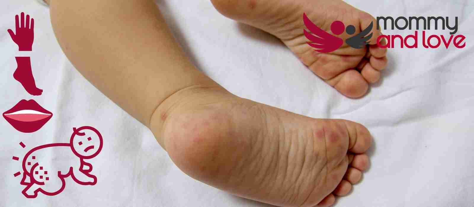 Can Hand Foot and Mouth Cause Diaper Rash