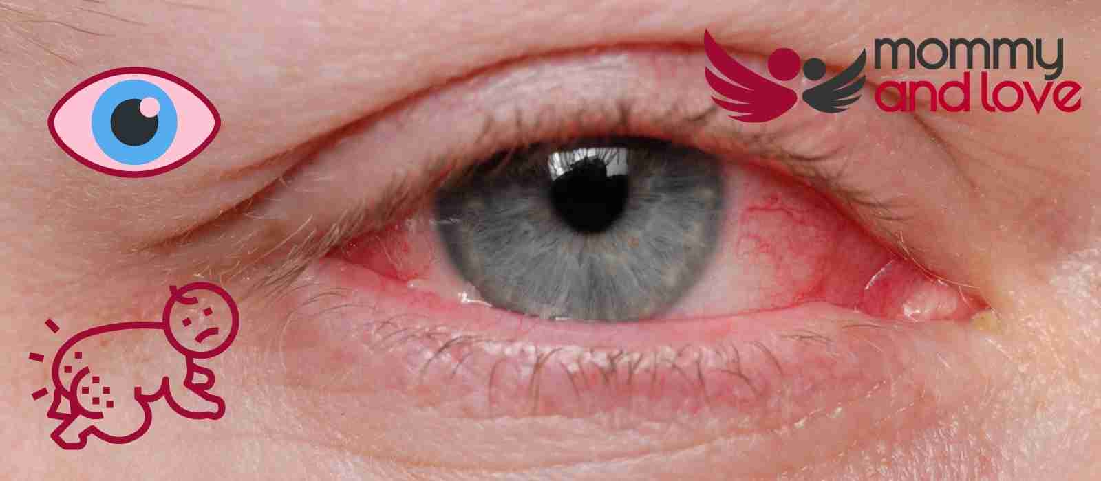Can Pink Eye Cause Diaper Rash