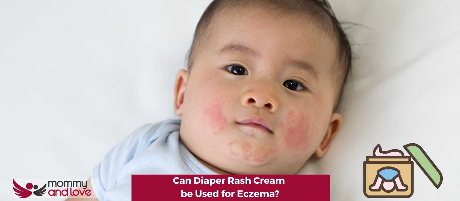 Can Diaper Rash Cream be Used for Eczema (1)