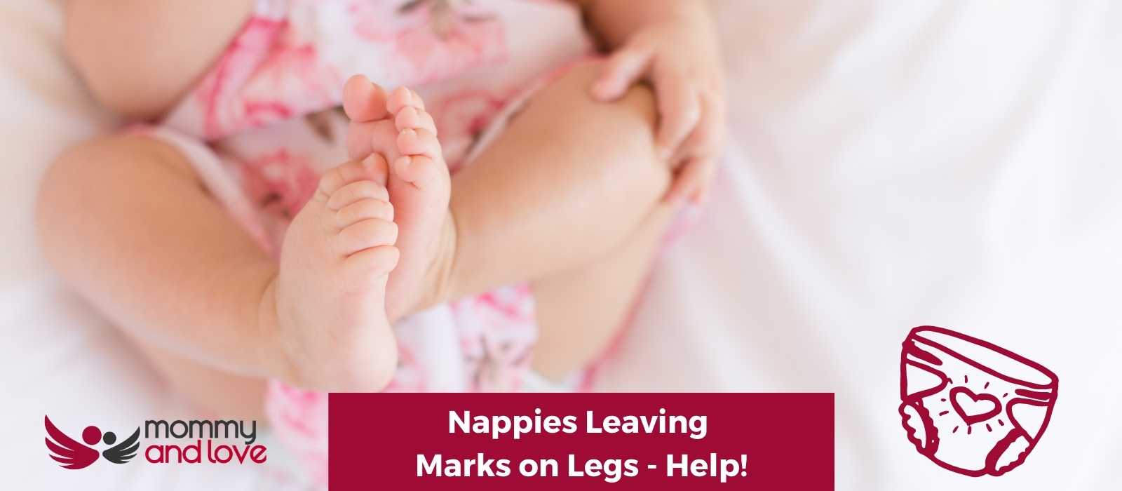 Nappies Leaving Marks on Legs - Help!